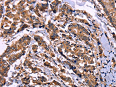 The image on the left is immunohistochemistry of paraffin-embedded Human breast cancer tissue using AMIGO2 Antibody(AMIGO2 Antibody) at dilution 1/50, on the right is treated with fusion protein. (Original magnification: ×200)