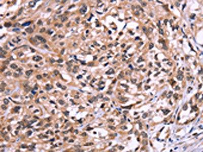 The image on the left is immunohistochemistry of paraffin-embedded Human esophagus cancer tissue using the antibody Antibody) at dilution 1/50, on the right is treated with fusion protein. (Original magnification: ×200)