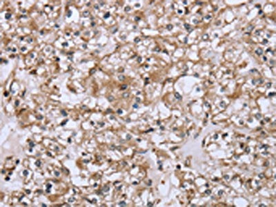 The image on the left is immunohistochemistry of paraffin-embedded Human prostate cancer tissue using FCAR Antibody(FCAR Antibody) at dilution 1/20, on the right is treated with fusion protein. (Original magnification: ×200)