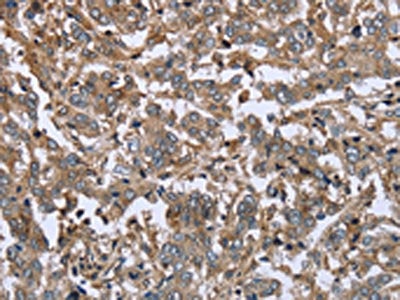 The image on the left is immunohistochemistry of paraffin-embedded Human liver cancer tissue using the antibody Antibody) at dilution 1/20, on the right is treated with fusion protein. (Original magnification: ×200)