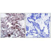 Immunohistochemistry analysis of paraffin-embedded human breast carcinoma tissue, using EGFR (Ab-1172) antibody.