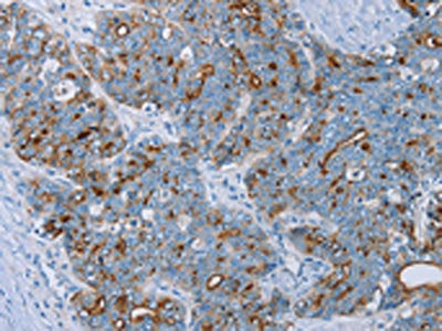 The image on the left is immunohistochemistry of paraffin-embedded Human cervical cancer tissue using MUC1 Antibody(MUC1 Antibody) at dilution 1/45, on the right is treated with synthetic peptide. (Original magnification: ×200)