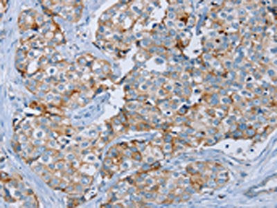 The image on the left is immunohistochemistry of paraffin-embedded Human breast cancer tissue using the antibody Antibody) at dilution 1/45, on the right is treated with synthetic peptide. (Original magnification: ×200)