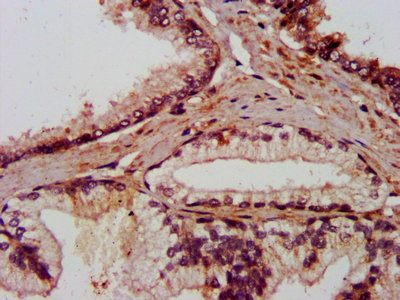 IHC image of AMIGO2 Antibody diluted at 1:800 and staining in paraffin-embedded human prostate cancer performed on a Leica BondTM system. After dewaxing and hydration, antigen retrieval was mediated by high pressure in a citrate buffer (pH 6.0). Section was blocked with 10% normal goat serum 30min at RT. Then primary antibody (1% BSA) was incubated at 4°C overnight. The primary is detected by a biotinylated secondary antibody and visualized using an HRP conjugated SP system.