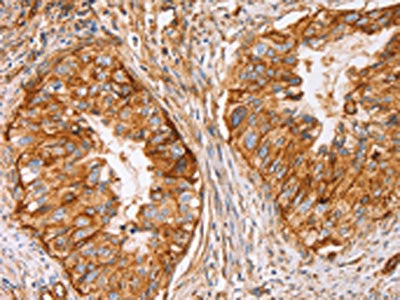 The image on the left is immunohistochemistry of paraffin-embedded Human cervical cancer tissue using CD59 Antibody(CD59 Antibody) at dilution 1/50, on the right is treated with synthetic peptide. (Original magnification: ×200)