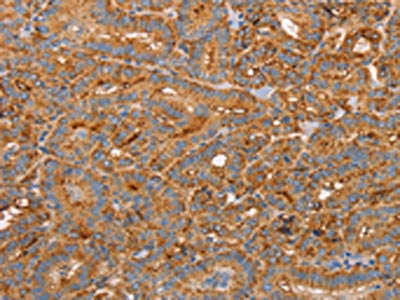 The image on the left is immunohistochemistry of paraffin-embedded Human thyroid cancer tissue using the antibody Antibody) at dilution 1/50, on the right is treated with synthetic peptide. (Original magnification: ×200)