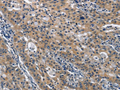 The image on the left is immunohistochemistry of paraffin-embedded Human gastric cancer tissue using CD160 Antibody(CD160 Antibody) at dilution 1/30, on the right is treated with fusion protein. (Original magnification: ×200)