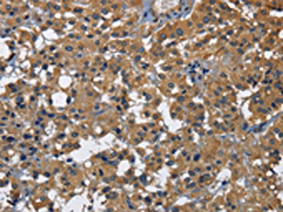 The image on the left is immunohistochemistry of paraffin-embedded Human thyroid cancer tissue using the antibody Antibody) at dilution 1/30, on the right is treated with fusion protein. (Original magnification: ×200)