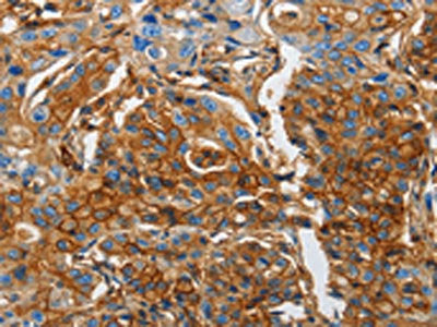 The image on the left is immunohistochemistry of paraffin-embedded Human lung cancer tissue using B2M Antibody(B2M Antibody) at dilution 1/25, on the right is treated with fusion protein. (Original magnification: ×200)