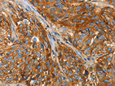 The image on the left is immunohistochemistry of paraffin-embedded Human esophagus cancer tissue using the antibody Antibody) at dilution 1/25, on the right is treated with fusion protein. (Original magnification: ×200)