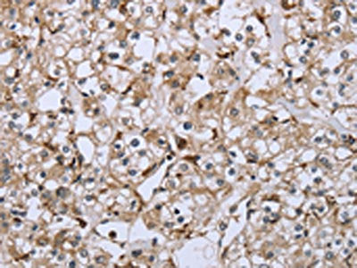 The image on the left is immunohistochemistry of paraffin-embedded Human prostate cancer tissue using FCGR2B Antibody(FCGR2B Antibody) at dilution 1/40, on the right is treated with fusion protein. (Original magnification: ×200)