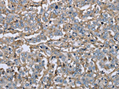 The image on the left is immunohistochemistry of paraffin-embedded Human liver cancer tissue using the antibody Antibody) at dilution 1/40, on the right is treated with fusion protein. (Original magnification: ×200)