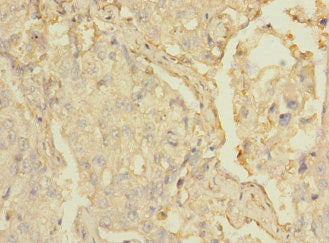 Immunohistochemistry of paraffin-embedded human lung cancer using MARCO Antibody at dilution of 1:100