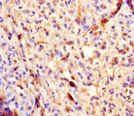 Immunohistochemistry of paraffin-embedded human melanoma using PLA2G2D Antibody at dilution of 1:100