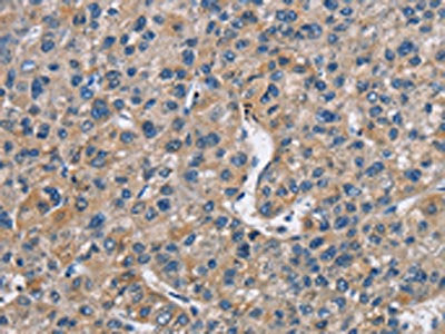 The image on the left is immunohistochemistry of paraffin-embedded Human liver cancer tissue using FLT3 Antibody(FLT3 Antibody) at dilution 1/30, on the right is treated with fusion protein. (Original magnification: ×200)