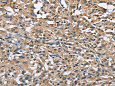 The image on the left is immunohistochemistry of paraffin-embedded Human thyroid cancer tissue using the antibody Antibody) at dilution 1/30, on the right is treated with fusion protein. (Original magnification: ×200)