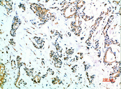 Immunohistochemical analysis of paraffin-embedded human-stomach-cancer, antibody was diluted at 1:200