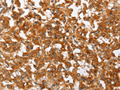 The image on the left is immunohistochemistry of paraffin-embedded Human thyroid cancer tissue using the antibody Antibody) at dilution 1/50, on the right is treated with fusion protein. (Original magnification: ×200)