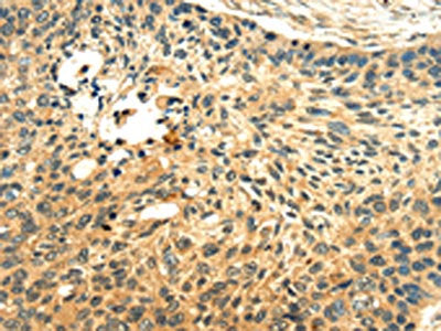 The image on the left is immunohistochemistry of paraffin-embedded Human esophagus cancer tissue using LILRB2 Antibody(LILRB2 Antibody) at dilution 1/20, on the right is treated with fusion protein. (Original magnification: ×200)