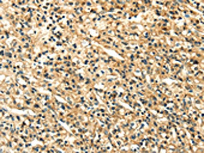 The image on the left is immunohistochemistry of paraffin-embedded Human prostate cancer tissue using the antibody Antibody) at dilution 1/20, on the right is treated with fusion protein. (Original magnification: ×200)