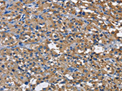 The image on the left is immunohistochemistry of paraffin-embedded Human thyroid cancer tissue using the antibody Antibody) at dilution 1/60, on the right is treated with fusion protein. (Original magnification: ×200)