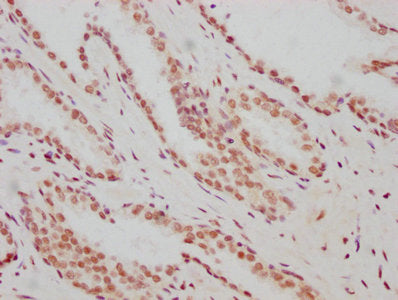 IHC image of ARNT Recombinant Monoclonal Antibody diluted at 1:183 and staining in paraffin-embedded human prostate cancer performed on a Leica BondTM system. After dewaxing and hydration, antigen retrieval was mediated by high pressure in a citrate buffer (pH 6.0). Section was blocked with 10% normal goat serum 30min at RT. Then primary antibody (1% BSA) was incubated at 4℃ overnight. The primary is detected by a biotinylated secondary antibody and visualized using an HRP conjugated SP system.