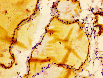 IHC image of BCL2 Recombinant Monoclonal Antibody diluted at 1:100 and staining in paraffin-embedded human thyroid tissue performed on a Leica BondTM system. After dewaxing and hydration, antigen retrieval was mediated by high pressure in a citrate buffer (pH 6.0). Section was blocked with 10% normal goat serum 30min at RT. Then primary antibody (1% BSA) was incubated at 4°C overnight. The primary is detected by a biotinylated secondary antibody and visualized using an HRP conjugated SP system.