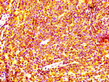 IHC image of BCL2 Recombinant Monoclonal Antibody diluted at 1:100 and staining in paraffin-embedded human lymph node tissue performed on a Leica BondTM system. After dewaxing and hydration, antigen retrieval was mediated by high pressure in a citrate buffer (pH 6.0). Section was blocked with 10% normal goat serum 30min at RT. Then primary antibody (1% BSA) was incubated at 4°C overnight. The primary is detected by a biotinylated secondary antibody and visualized using an HRP conjugated SP system.