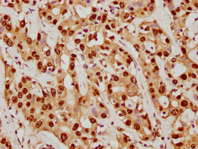 IHC image of SUMO1 Recombinant Monoclonal Antibody diluted at 1:92.5 and staining in paraffin-embedded human liver cancer performed on a Leica BondTM system. After dewaxing and hydration, antigen retrieval was mediated by high pressure in a citrate buffer (pH 6.0). Section was blocked with 10% normal goat serum 30min at RT. Then primary antibody (1% BSA) was incubated at 4℃ overnight. The primary is detected by a biotinylated secondary antibody and visualized using an HRP conjugated SP system.