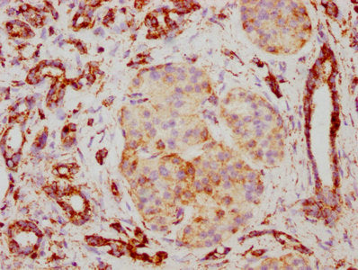 IHC image of TSPO Recombinant Monoclonal Antibody diluted at 1:117 and staining in paraffin-embedded human pancreatic cancer performed on a Leica BondTM system. After dewaxing and hydration, antigen retrieval was mediated by high pressure in a citrate buffer (pH 6.0). Section was blocked with 10% normal goat serum 30min at RT. Then primary antibody (1% BSA) was incubated at 4℃ overnight. The primary is detected by a biotinylated secondary antibody and visualized using an HRP conjugated SP system.