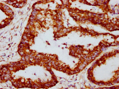 IHC image of TSPO Recombinant Monoclonal Antibody diluted at 1:117 and staining in paraffin-embedded human colon cancer performed on a Leica BondTM system. After dewaxing and hydration, antigen retrieval was mediated by high pressure in a citrate buffer (pH 6.0). Section was blocked with 10% normal goat serum 30min at RT. Then primary antibody (1% BSA) was incubated at 4℃ overnight. The primary is detected by a biotinylated secondary antibody and visualized using an HRP conjugated SP system.