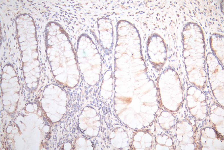 IHC image of the antibody diluted at 1:300 and staining in paraffin-embedded human colorectal cancer performed on a Leica BondTM system. After dewaxing and hydration, antigen retrieval was mediated by high pressure in a citrate buffer (pH 6.0). Section was blocked with 10% normal goat serum 30min at RT. Then primary antibody (1% BSA) was incubated at 4°C overnight. The primary is detected by a Goat anti-Mouse IgG labeled by HRP and visualized using 0.05% DAB.