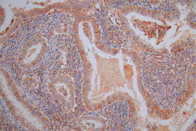 IHC image of VIM Recombinant Monoclonal Antibody diluted at 1:40 and staining in paraffin-embedded human endometrial cancer performed on a Leica BondTM system. After dewaxing and hydration, antigen retrieval was mediated by high pressure in a citrate buffer (pH 6.0). Section was blocked with 10% normal goat serum 30min at RT. Then primary antibody (1% BSA) was incubated at 4°C overnight. The primary is detected by a Goat anti-Rabbit IgG labeled by HRP and visualized using 0.05% DAB.