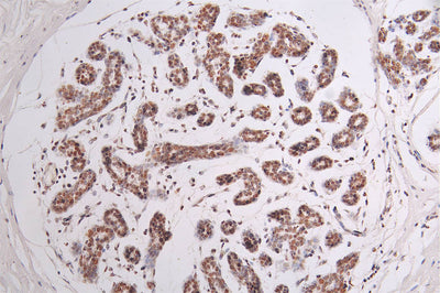 IHC image of SMARCA4 Recombinant Monoclonal Antibody diluted at 1:50 and staining in paraffin-embedded human breast cancer performed on a Leica BondTM system. After dewaxing and hydration, antigen retrieval was mediated by high pressure in a citrate buffer (pH 6.0). Section was blocked with 10% normal goat serum 30min at RT. Then primary antibody (1% BSA) was incubated at 4°C overnight. The primary is detected by a Goat anti-rabbit polymer IgG labeled by HRP and visualized using 0.44% DAB.