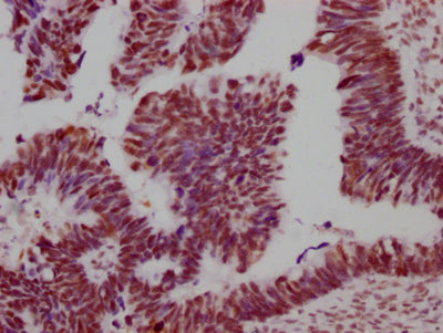 IHC image of SMC1A Recombinant Monoclonal Antibody diluted at 1:100 and staining in paraffin-embedded human ovarian cancer performed on a Leica BondTM system. After dewaxing and hydration, antigen retrieval was mediated by high pressure in a citrate buffer (pH 6.0). Section was blocked with 10% normal goat serum 30min at RT. Then primary antibody (1% BSA) was incubated at 4℃ overnight. The primary is detected by a Goat anti-rabbit IgG polymer labeled by HRP and visualized using 0.05% DAB.