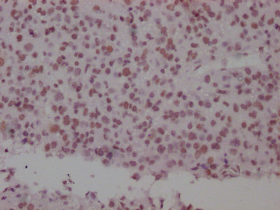 IHC image of SMC1A Recombinant Monoclonal Antibody diluted at 1:100 and staining in paraffin-embedded human glioma cancer performed on a Leica BondTM system. After dewaxing and hydration, antigen retrieval was mediated by high pressure in a citrate buffer (pH 6.0). Section was blocked with 10% normal goat serum 30min at RT. Then primary antibody (1% BSA) was incubated at 4℃ overnight. The primary is detected by a Goat anti-rabbit IgG polymer labeled by HRP and visualized using 0.05% DAB.