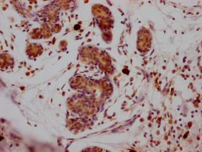 IHC image of SUZ12 Recombinant Monoclonal Antibody diluted at 1:100 and staining in paraffin-embedded human breast cancer performed on a Leica BondTM system. After dewaxing and hydration, antigen retrieval was mediated by high pressure in a citrate buffer (pH 6.0). Section was blocked with 10% normal goat serum 30min at RT. Then primary antibody (1% BSA) was incubated at 4℃ overnight. The primary is detected by a Goat anti-rabbit IgG polymer labeled by HRP and visualized using 0.05% DAB.