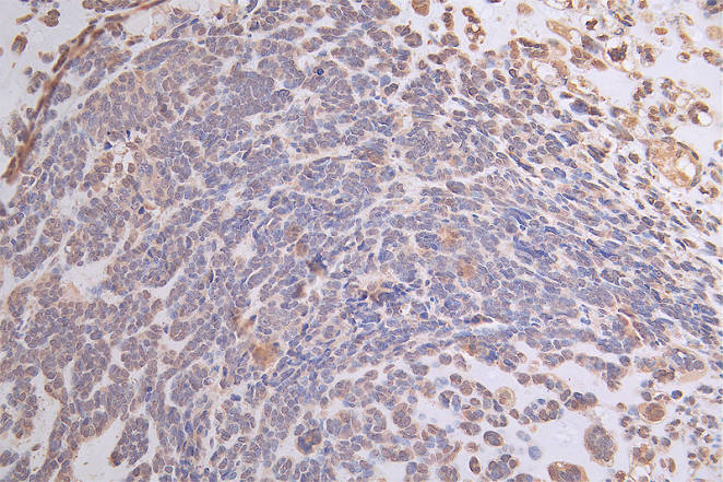 IHC image of ATP7B Recombinant Monoclonal Antibody diluted at 1:50 and staining in paraffin-embedded human ovarian cancer performed on a Leica BondTM system. After dewaxing and hydration, antigen retrieval was mediated by high pressure in a citrate buffer (pH 6.0). Section was blocked with 10% normal goat serum 30min at RT. Then primary antibody (1% BSA) was incubated at 4°C overnight. The primary is detected by a Goat anti-rabbit polymer IgG labeled by HRP and visualized using 0.19% DAB.