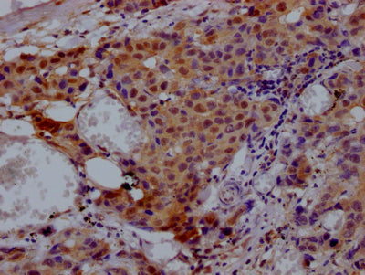 IHC image of VCP Recombinant Monoclonal Antibody diluted at 1:100 and staining in paraffin-embedded human breast cancer performed on a Leica BondTM system. After dewaxing and hydration, antigen retrieval was mediated by high pressure in a citrate buffer (pH 6.0). Section was blocked with 10% normal goat serum 30min at RT. Then primary antibody (1% BSA) was incubated at 4℃ overnight. The primary is detected by a Goat anti-rabbit IgG polymer labeled by HRP and visualized using 0.05% DAB.