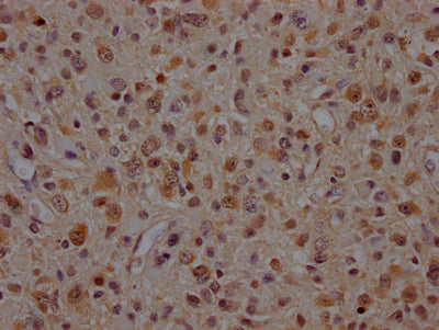 IHC image of VCP Recombinant Monoclonal Antibody diluted at 1:100 and staining in paraffin-embedded human glioma cancer performed on a Leica BondTM system. After dewaxing and hydration, antigen retrieval was mediated by high pressure in a citrate buffer (pH 6.0). Section was blocked with 10% normal goat serum 30min at RT. Then primary antibody (1% BSA) was incubated at 4℃ overnight. The primary is detected by a Goat anti-rabbit IgG polymer labeled by HRP and visualized using 0.05% DAB.