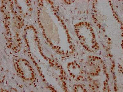 IHC image of USP7 Recombinant Monoclonal Antibody diluted at 1:100 and staining in paraffin-embedded human prostate cancer performed on a Leica BondTM system. After dewaxing and hydration, antigen retrieval was mediated by high pressure in a citrate buffer (pH 6.0). Section was blocked with 10% normal goat serum 30min at RT. Then primary antibody (1% BSA) was incubated at 4℃ overnight. The primary is detected by a Goat anti-rabbit IgG polymer labeled by HRP and visualized using 0.05% DAB.