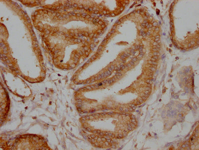 IHC image of TPT1 Recombinant Monoclonal Antibody diluted at 1:100 and staining in paraffin-embedded human prostate tissue performed on a Leica BondTM system. After dewaxing and hydration, antigen retrieval was mediated by high pressure in a citrate buffer (pH 6.0). Section was blocked with 10% normal goat serum 30min at RT. Then primary antibody (1% BSA) was incubated at 4℃ overnight. The primary is detected by a Goat anti-rabbit IgG polymer labeled by HRP and visualized using 0.05% DAB.