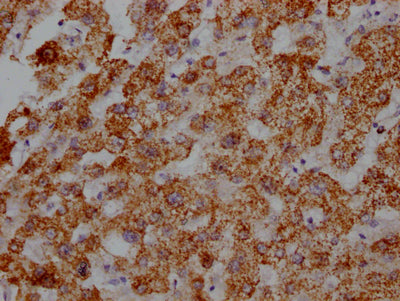 IHC image of ATP5B Recombinant Monoclonal Antibody diluted at 1:100 and staining in paraffin-embedded human liver tissue performed on a Leica BondTM system. After dewaxing and hydration, antigen retrieval was mediated by high pressure in a citrate buffer (pH 6.0). Section was blocked with 10% normal goat serum 30min at RT. Then primary antibody (1% BSA) was incubated at 4℃ overnight. The primary is detected by a Goat anti-rabbit IgG polymer labeled by HRP and visualized using 0.05% DAB.