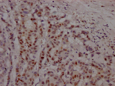 IHC image of AR Recombinant Monoclonal Antibody diluted at 1:100 and staining in paraffin-embedded human breast cancer performed on a Leica BondTM system. After dewaxing and hydration, antigen retrieval was mediated by high pressure in a citrate buffer (pH 6.0). Section was blocked with 10% normal goat serum 30min at RT. Then primary antibody (1% BSA) was incubated at 4℃ overnight. The primary is detected by a Goat anti-rabbit IgG polymer labeled by HRP and visualized using 0.05% DAB.