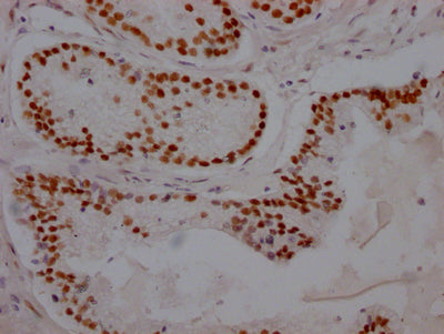 IHC image of AR Recombinant Monoclonal Antibody diluted at 1:100 and staining in paraffin-embedded human prostate cancer performed on a Leica BondTM system. After dewaxing and hydration, antigen retrieval was mediated by high pressure in a citrate buffer (pH 6.0). Section was blocked with 10% normal goat serum 30min at RT. Then primary antibody (1% BSA) was incubated at 4℃ overnight. The primary is detected by a Goat anti-rabbit IgG polymer labeled by HRP and visualized using 0.05% DAB.