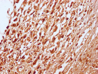 IHC image of RNF20 Recombinant Monoclonal Antibody diluted at 1:100 and staining in paraffin-embedded human melanoma cancer performed on a Leica BondTM system. After dewaxing and hydration, antigen retrieval was mediated by high pressure in a citrate buffer (pH 6.0). Section was blocked with 10% normal goat serum 30min at RT. Then primary antibody (1% BSA) was incubated at 4℃ overnight. The primary is detected by a Goat anti-rabbit IgG polymer labeled by HRP and visualized using 0.05% DAB.