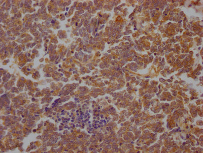 IHC image of STAT3 Recombinant Monoclonal Antibody diluted at 1:100 and staining in paraffin-embedded human lung cancer performed on a Leica BondTM system. After dewaxing and hydration, antigen retrieval was mediated by high pressure in a citrate buffer (pH 6.0). Section was blocked with 10% normal goat serum 30min at RT. Then primary antibody (1% BSA) was incubated at 4℃ overnight. The primary is detected by a Goat anti-rabbit IgG polymer labeled by HRP and visualized using 0.05% DAB.