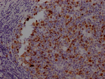 IHC image of AURKB Recombinant Monoclonal Antibody diluted at 1:100 and staining in paraffin-embedded human tonsil tissue performed on a Leica BondTM system. After dewaxing and hydration, antigen retrieval was mediated by high pressure in a citrate buffer (pH 6.0). Section was blocked with 10% normal goat serum 30min at RT. Then primary antibody (1% BSA) was incubated at 4℃ overnight. The primary is detected by a Goat anti-rabbit IgG polymer labeled by HRP and visualized using 0.05% DAB.