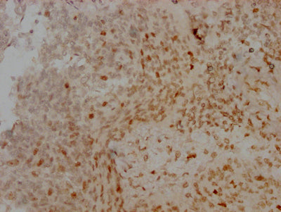 IHC image of AURKB Recombinant Monoclonal Antibody diluted at 1:100 and staining in paraffin-embedded human cervical cancer performed on a Leica BondTM system. After dewaxing and hydration, antigen retrieval was mediated by high pressure in a citrate buffer (pH 6.0). Section was blocked with 10% normal goat serum 30min at RT. Then primary antibody (1% BSA) was incubated at 4℃ overnight. The primary is detected by a Goat anti-rabbit IgG polymer labeled by HRP and visualized using 0.05% DAB.