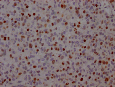 IHC image of TP53 Recombinant Monoclonal Antibody diluted at 1:100 and staining in paraffin-embedded human glioma cancer performed on a Leica BondTM system. After dewaxing and hydration, antigen retrieval was mediated by high pressure in a citrate buffer (pH 6.0). Section was blocked with 10% normal goat serum 30min at RT. Then primary antibody (1% BSA) was incubated at 4℃ overnight. The primary is detected by a Goat anti-rabbit IgG polymer labeled by HRP and visualized using 0.05% DAB.